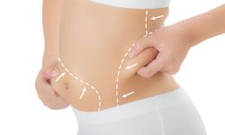 Liposuction ile Yağlarınızdan Kurtulun